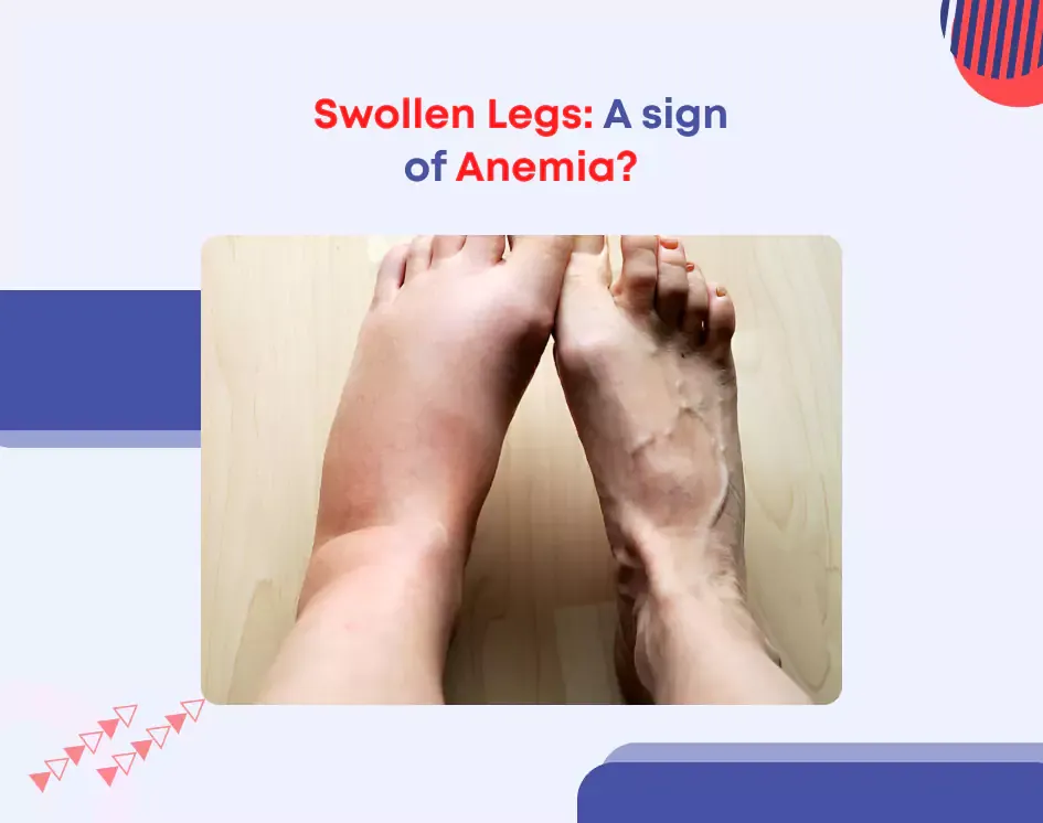 Swollen Legs: A sign of Anemia?
