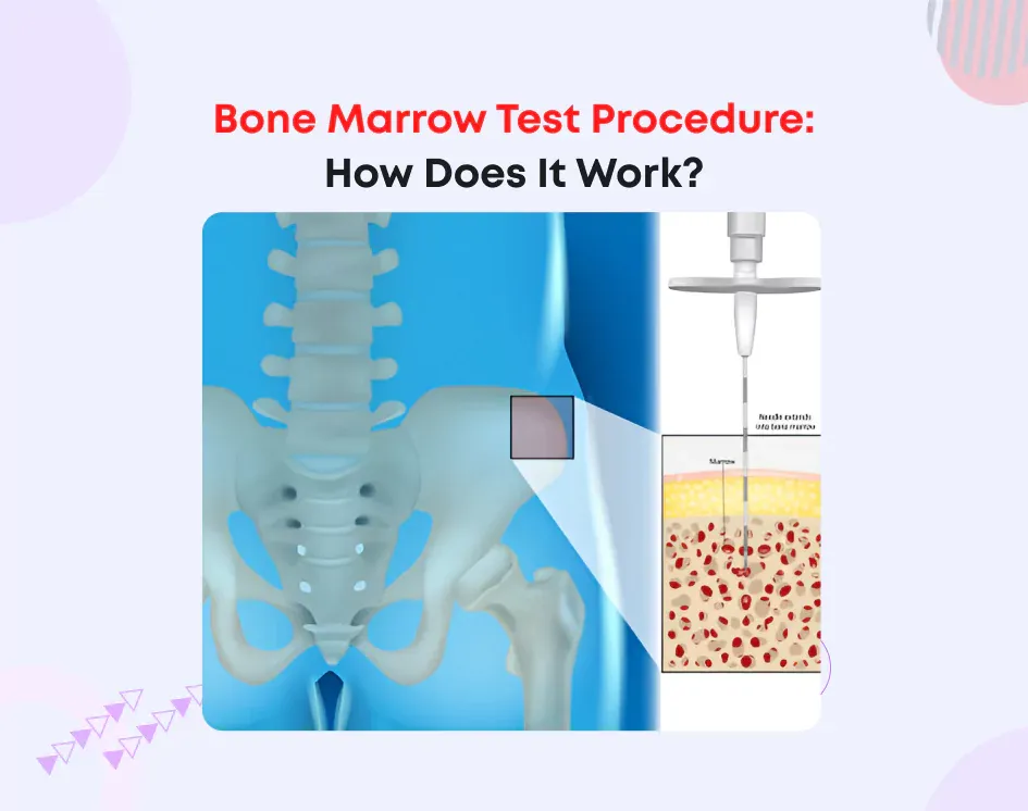 Bone Marrow Test Procedure: How Does It Work?