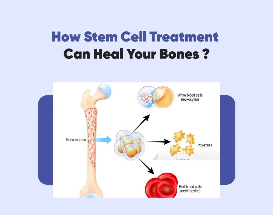 How Stem Cell Treatment Can Heal Your Bones?