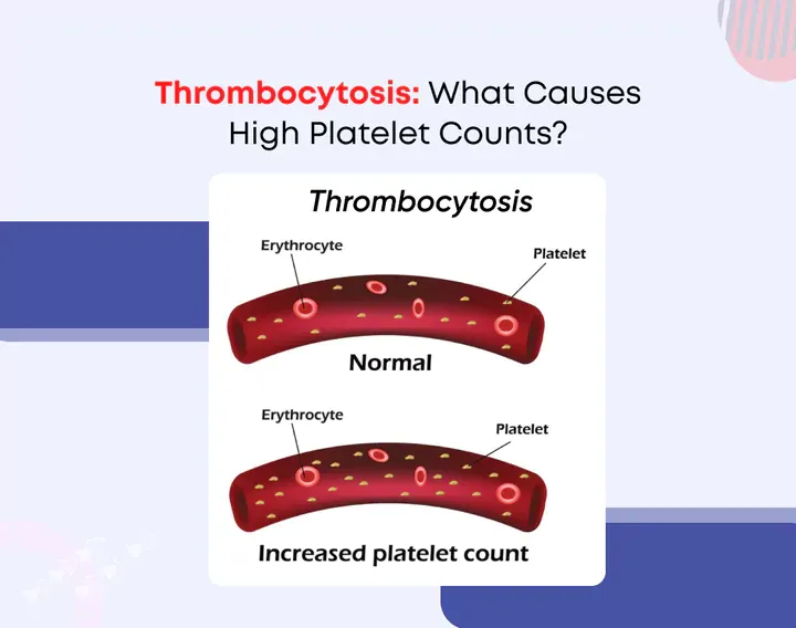 Thrombocytosis: What Causes High Platelet Counts?